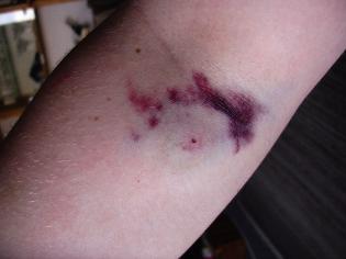 Blutspenden-Arm